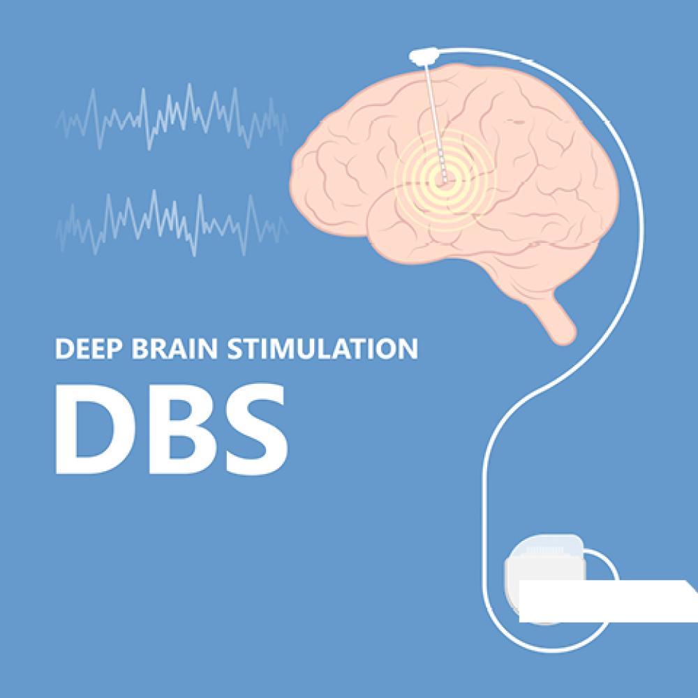 An illustration of a deep brain stimulation device