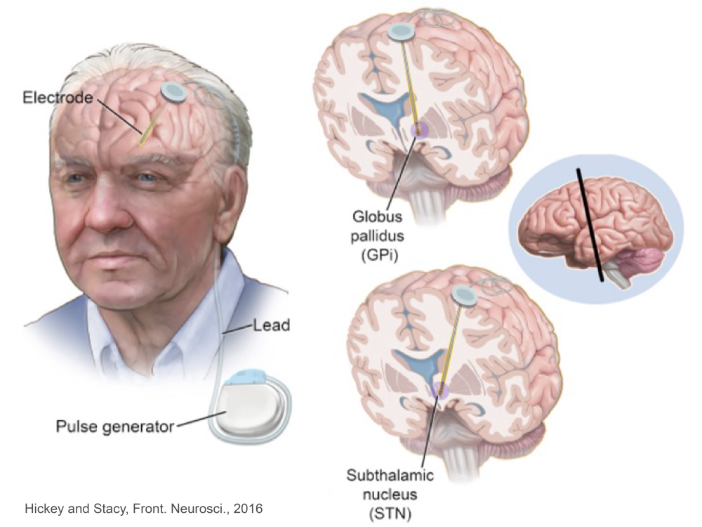 Figure depicting DBS targets