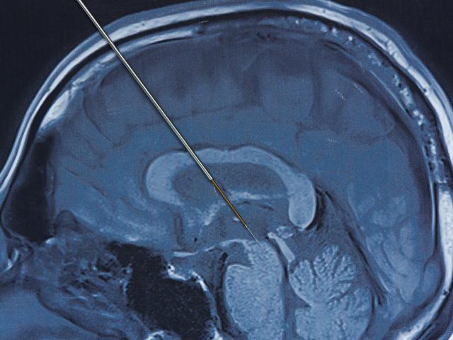Microelectrode recording on magnetic resonance imaging of human brain
