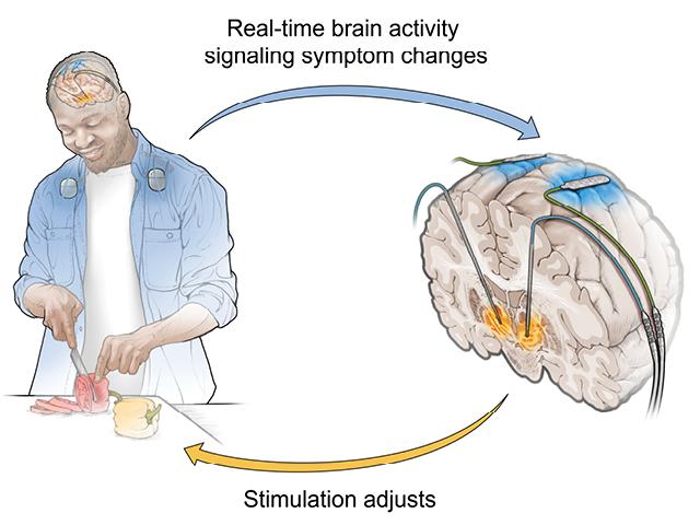 A figure depicting how adaptive deep brain stimulation works