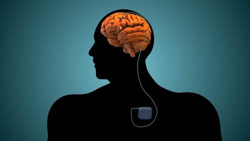 A 3D illustration of deep brain stimulation