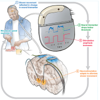An illustration of a deep brain stimulation device